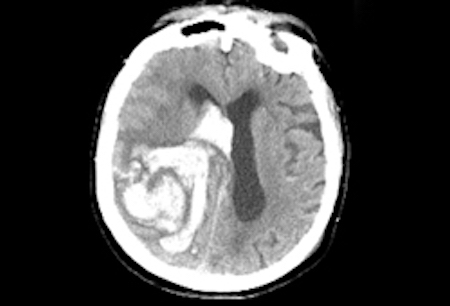Stroke due to spontaneous intracerebral haemorrhage images